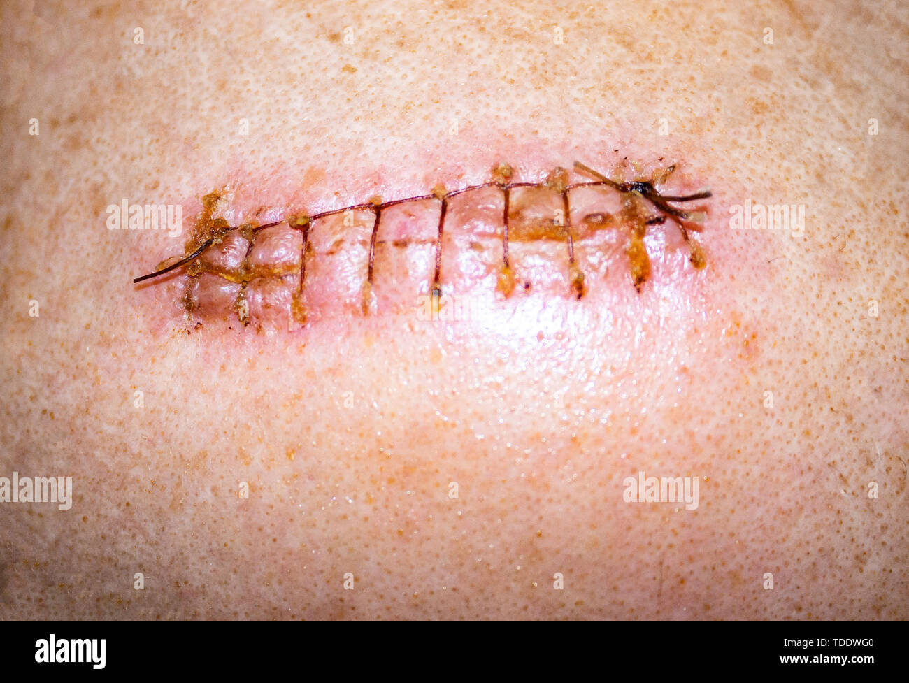 Scar from surgery with thread. Stock Photo