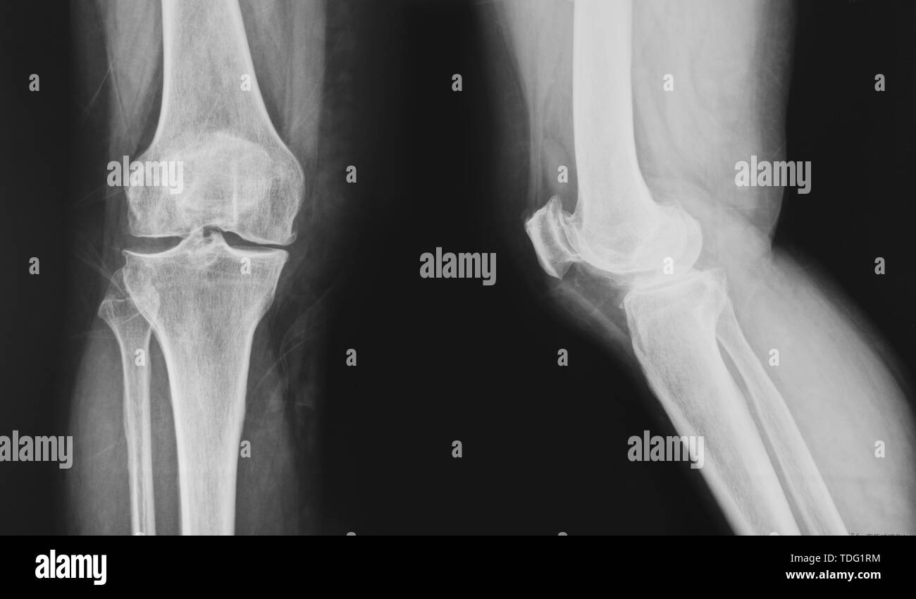 Collection of x-ray normal knee Stock Photo