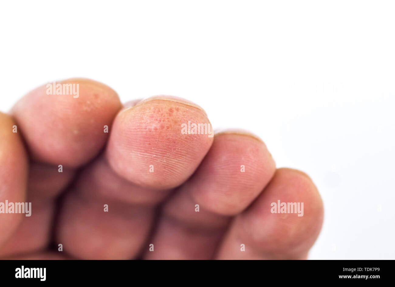 Advanced stage of dyshidrosis on fingers,cracked and peeling skin, white background. Skin