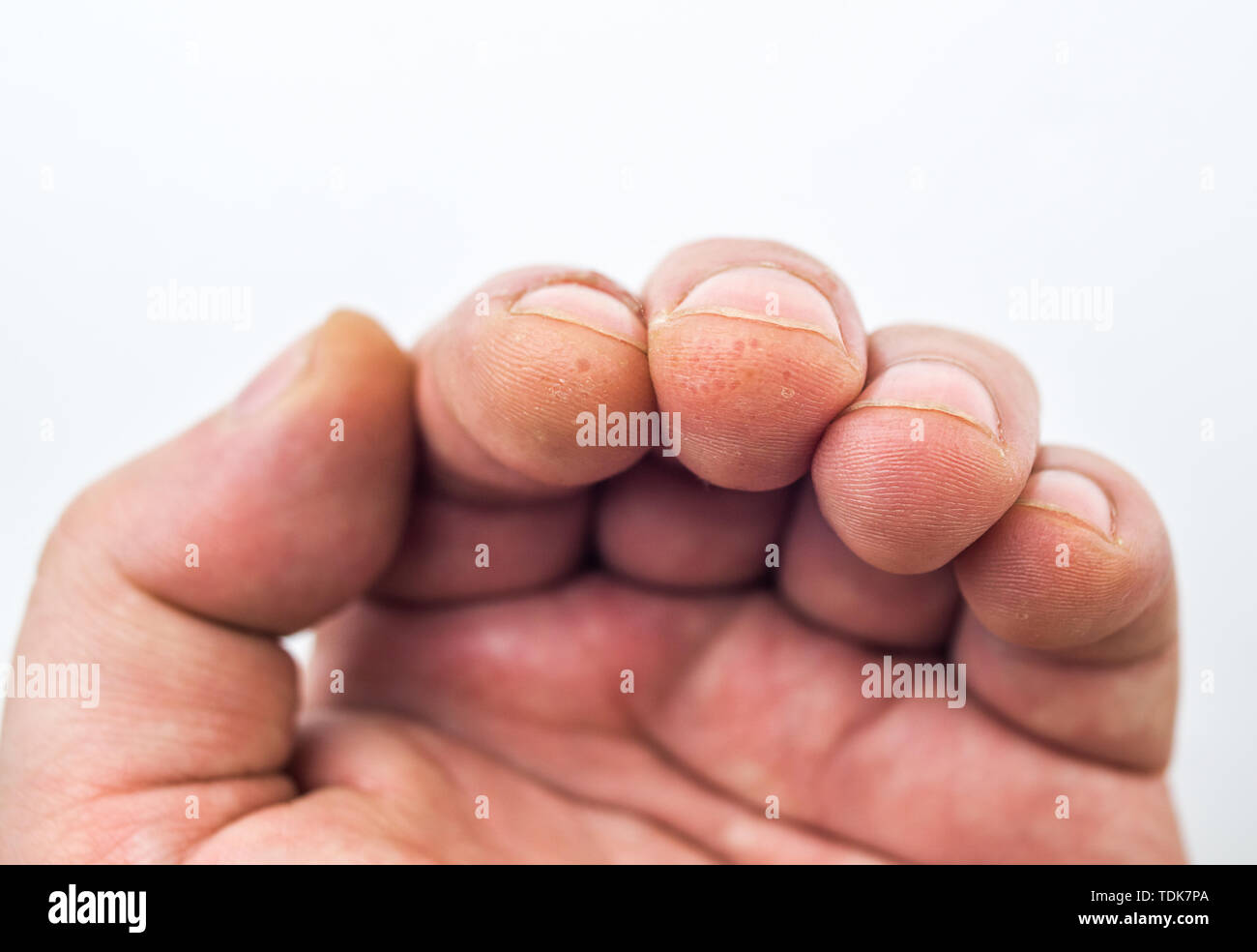 Peau Du Gland Qui Pele Et Odeur Advanced stage of dyshidrosis on fingers,cracked and peeling skin