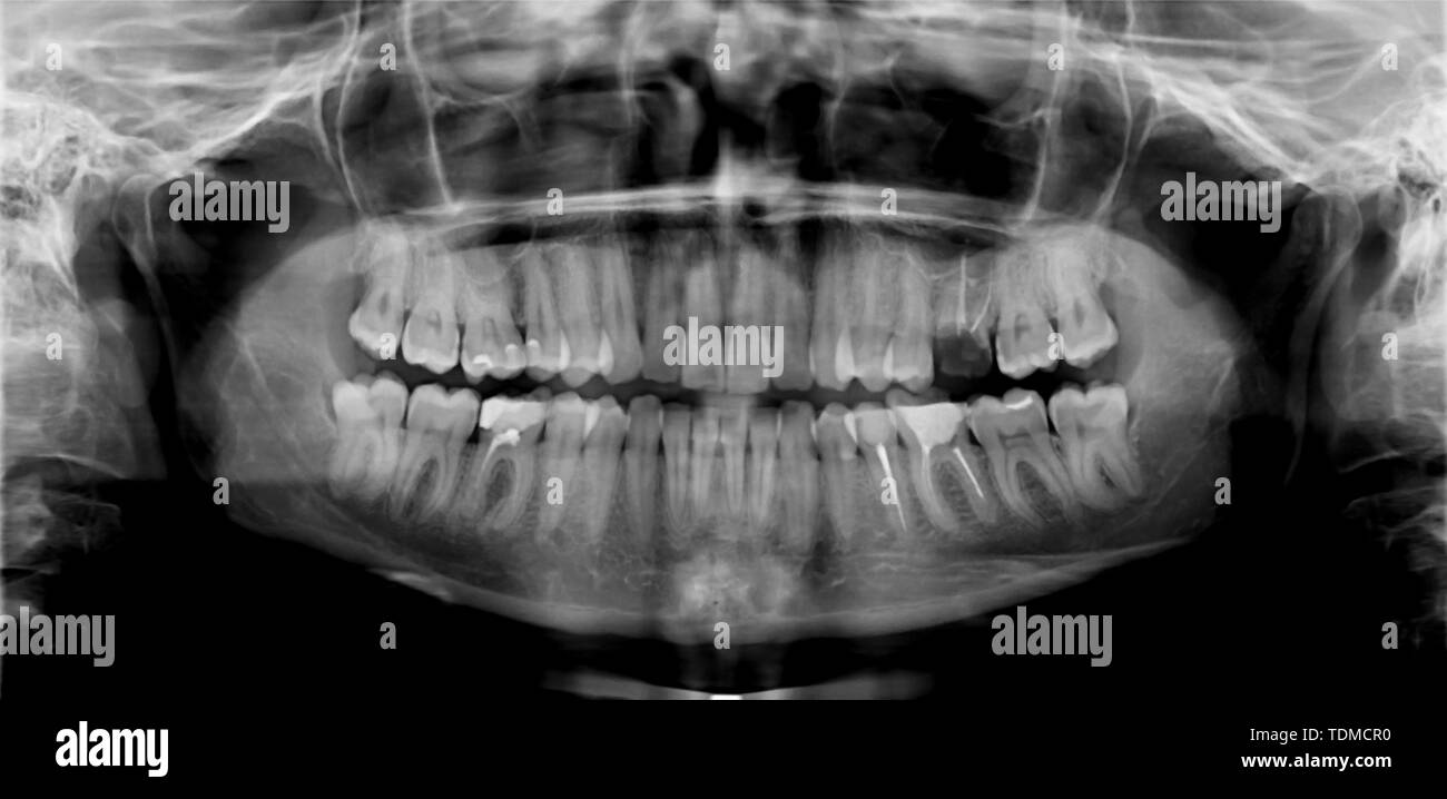 Mandible x ray Black and White Stock Photos & Images Alamy