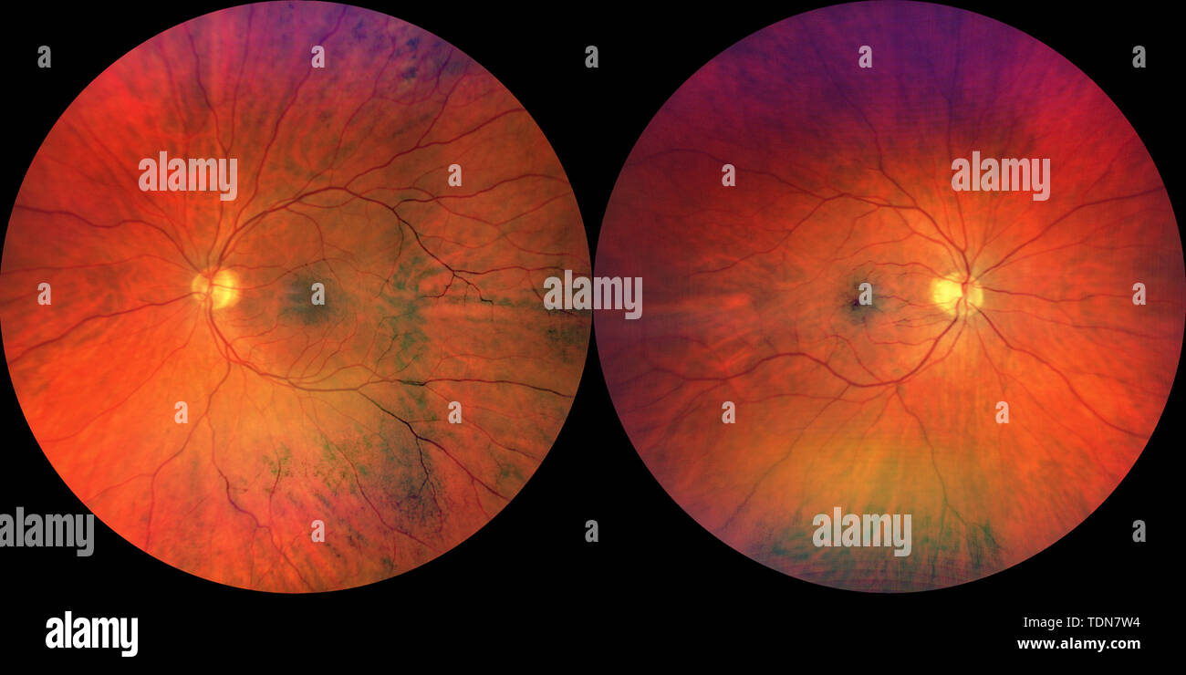 Photograph of the Fundus Oculi: left and right eye Stock Photo