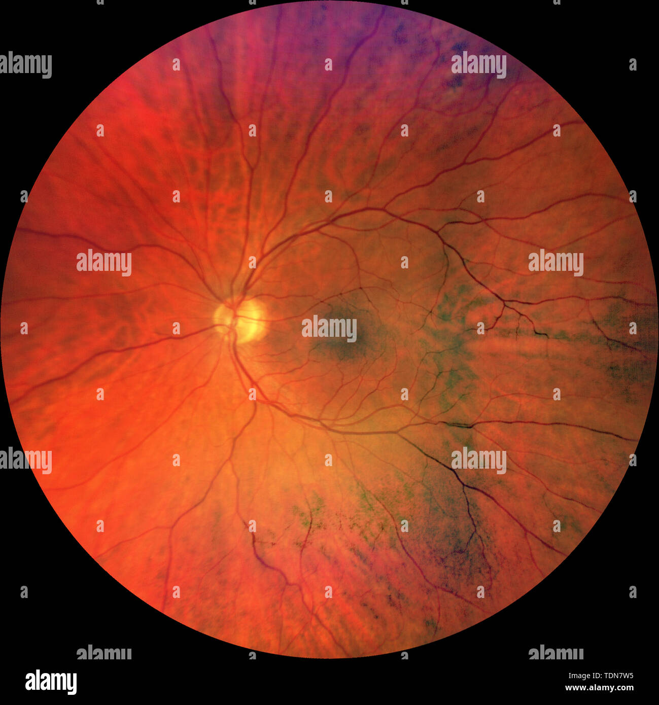 Photograph of the Fundus Oculi: left eye Stock Photo