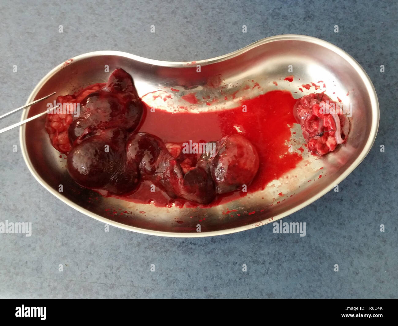 kidney dish with splenic tumor Stock Photo