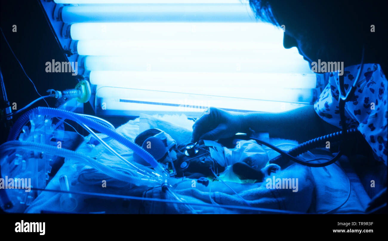 Bathed in blue ultraviolet light, a premature infant is monitored by a