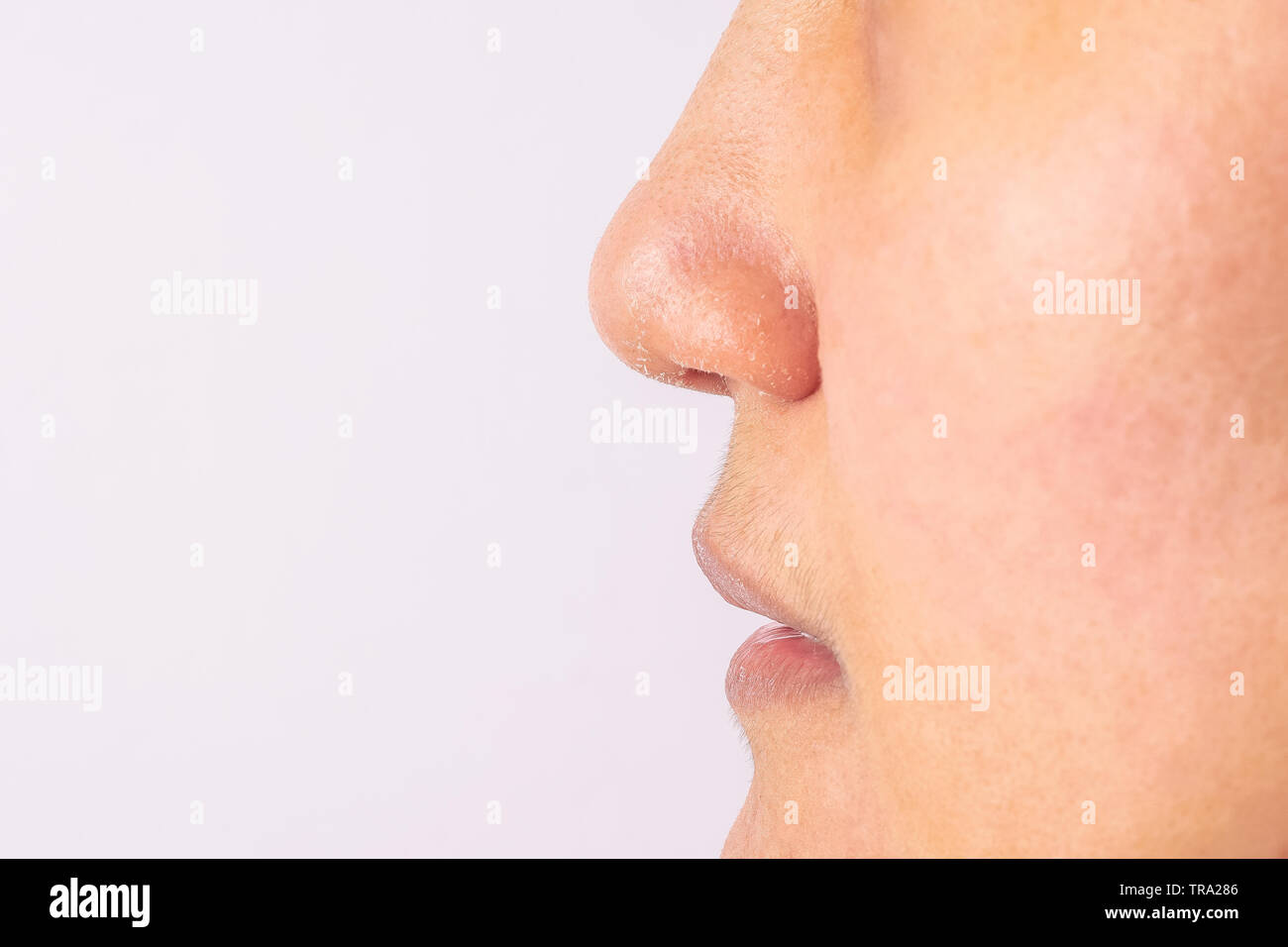Allergic women have eczema dry nose and lips on winter season closeup