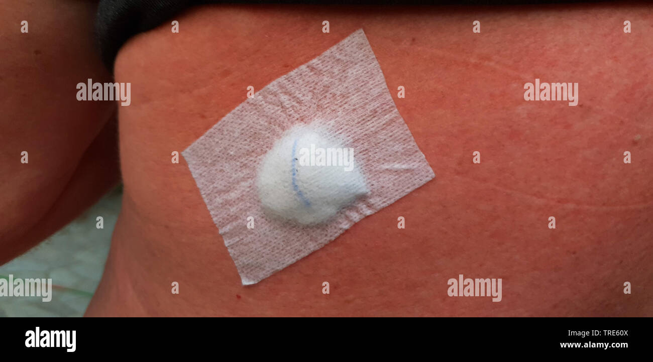 plasters covering removed melanomas on the back of a man, Germany Stock Photo