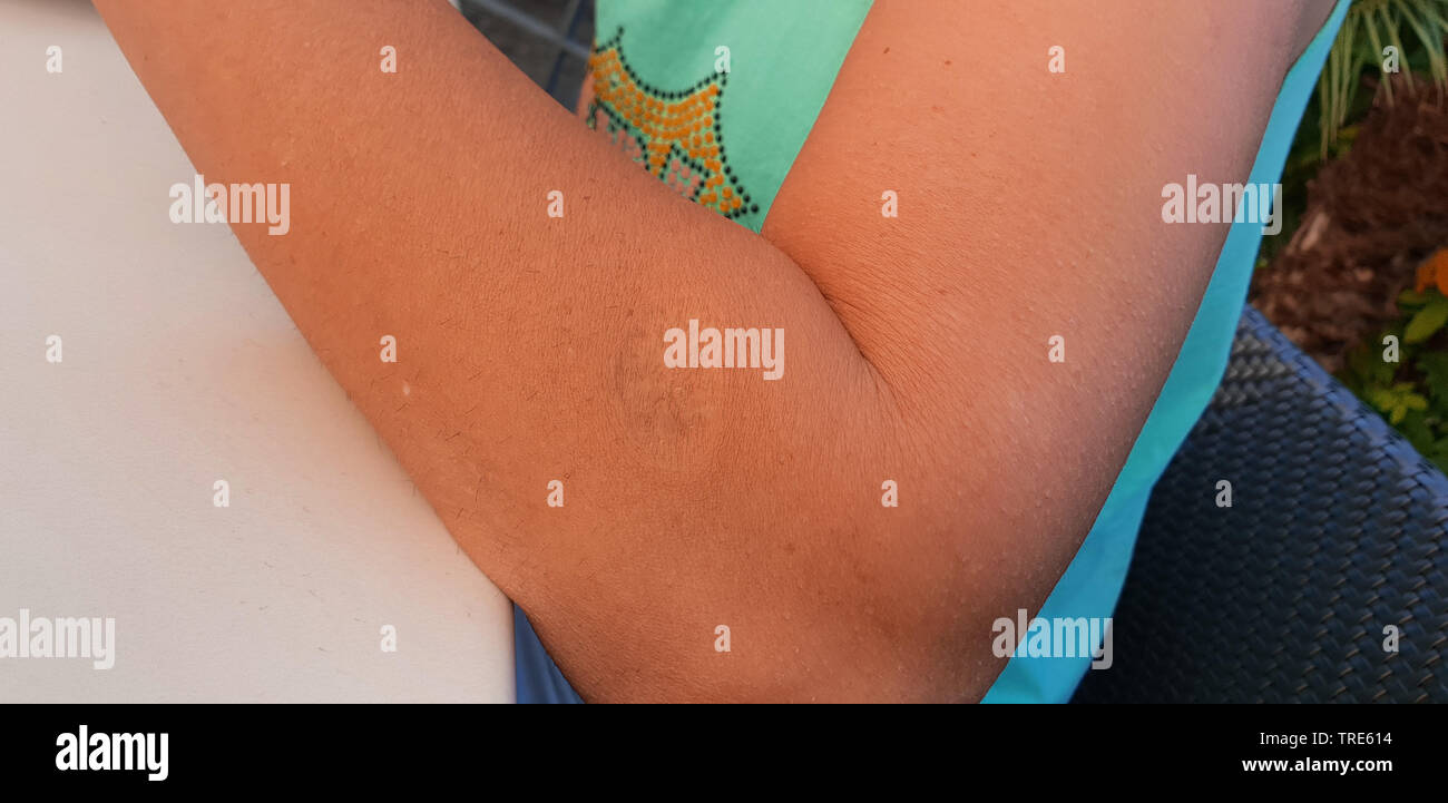 scar of a variola vaccination on an arm of a Turkish woman, Turkey Stock Photo