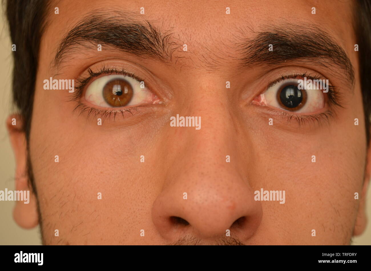 My Eyesssss!!!!!!!!! - What the Mydriatic did with my eye. Stock Photo