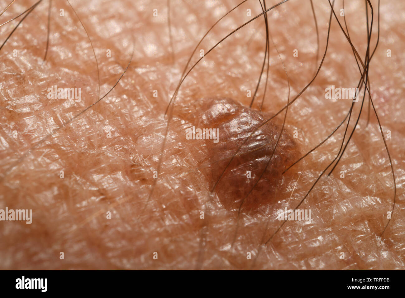 Close up of a skin mole nevus on a hairy arm Stock Photo