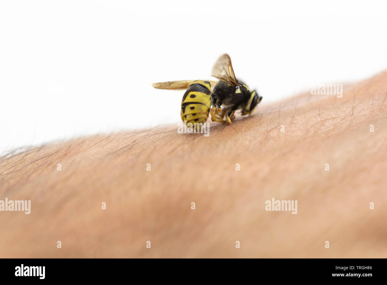 Bee stings in human skin, macro shot Stock Photo