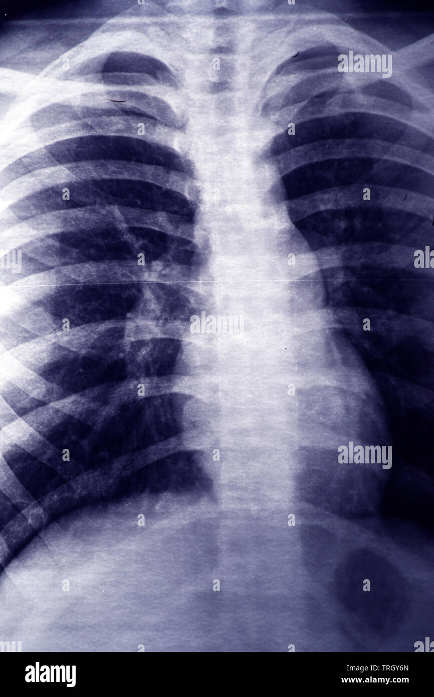 X Ray Of Lungs With Asthma