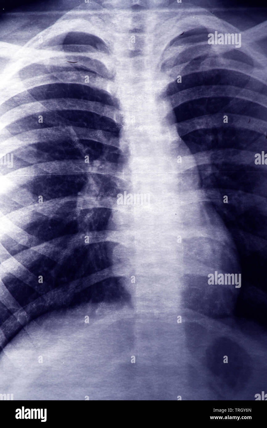 close up image of X-ray of the chest Stock Photo