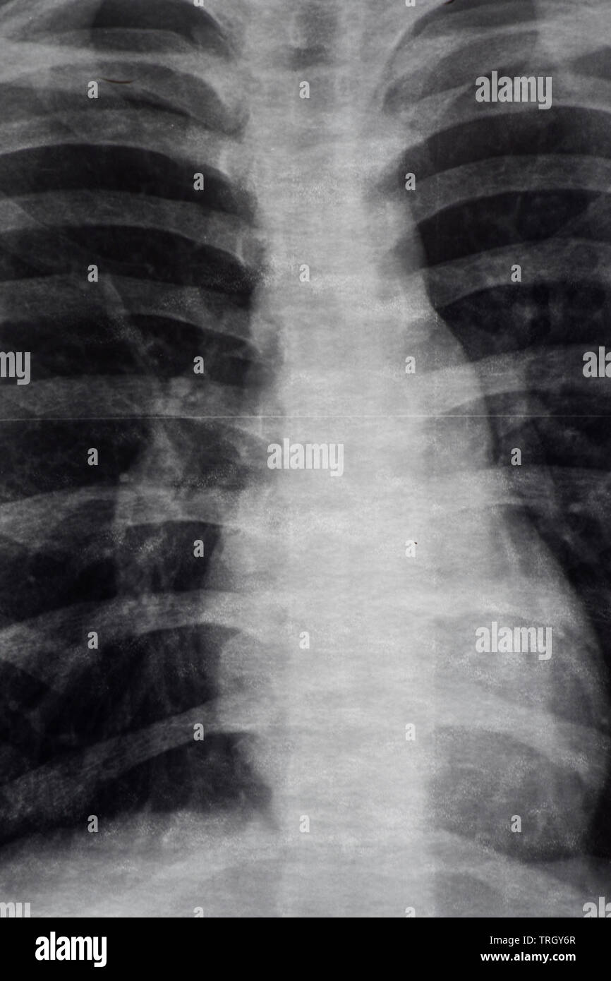 X-Ray Image Of human Chest for a medical diagnosis Stock Photo
