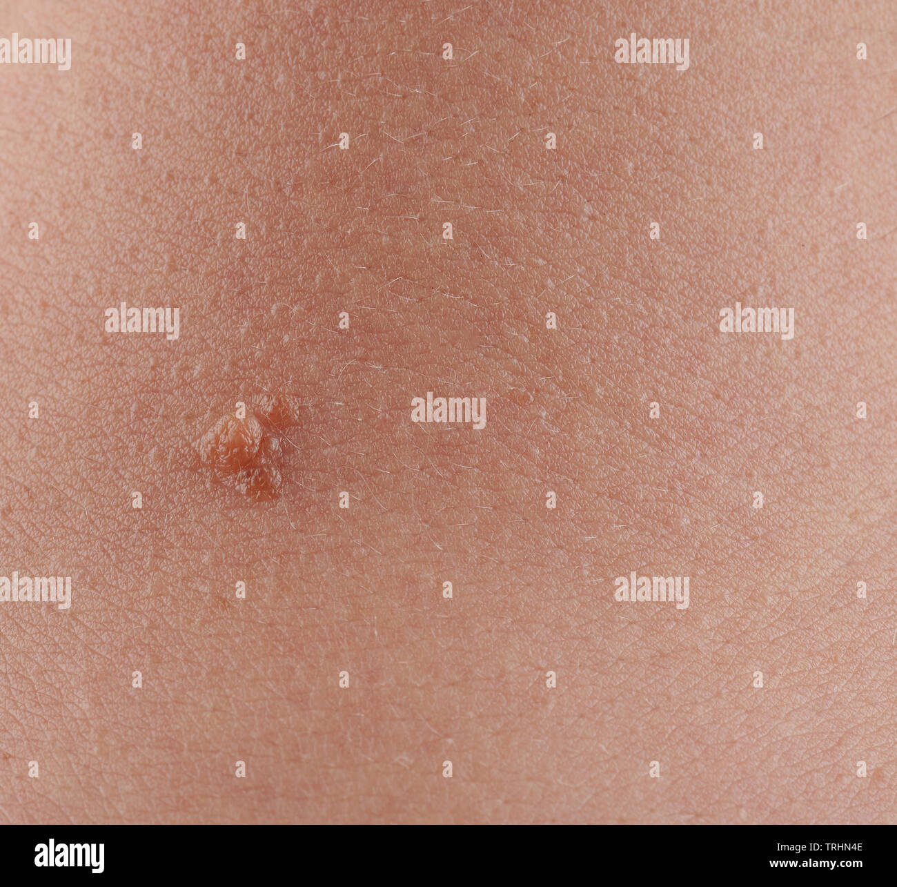 One mole spot on human skin close up view Stock Photo