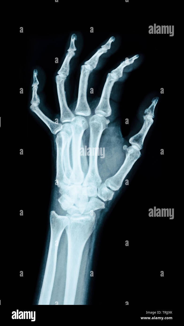 Broken Knuckles From Punching