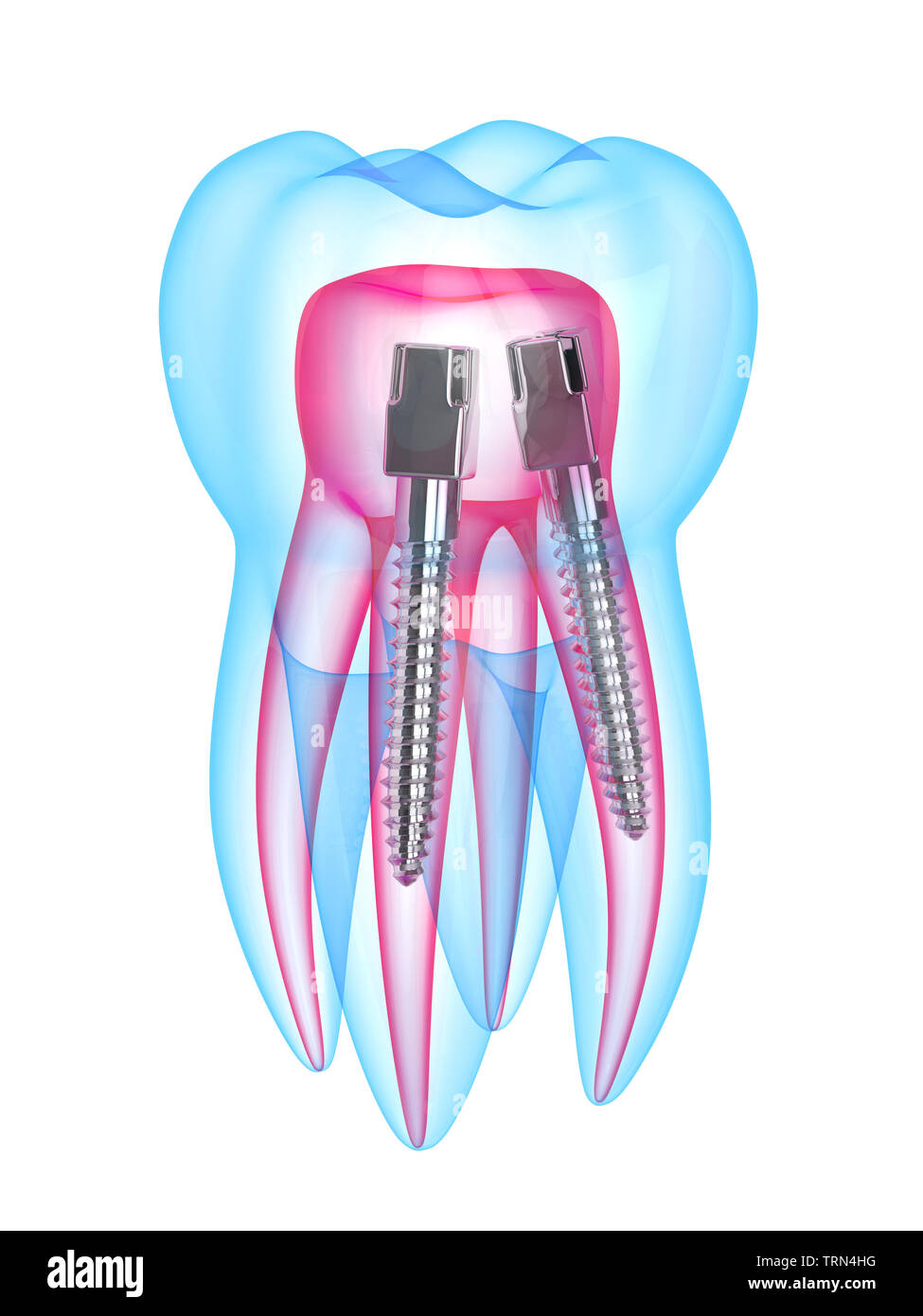3d render of xray tooth with stainless steel dental post over white