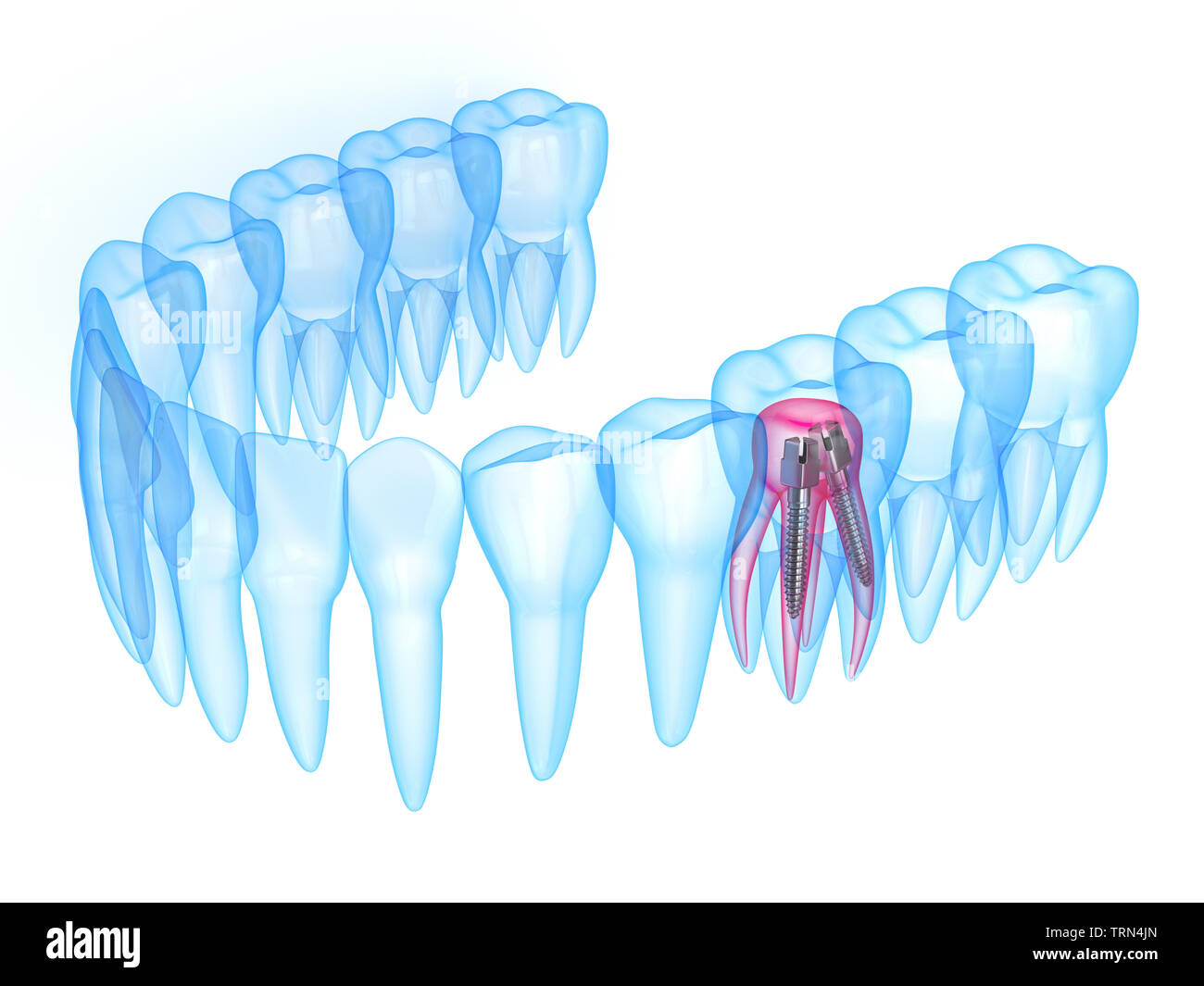 3d render of xray teeth with stainless steel dental post over white