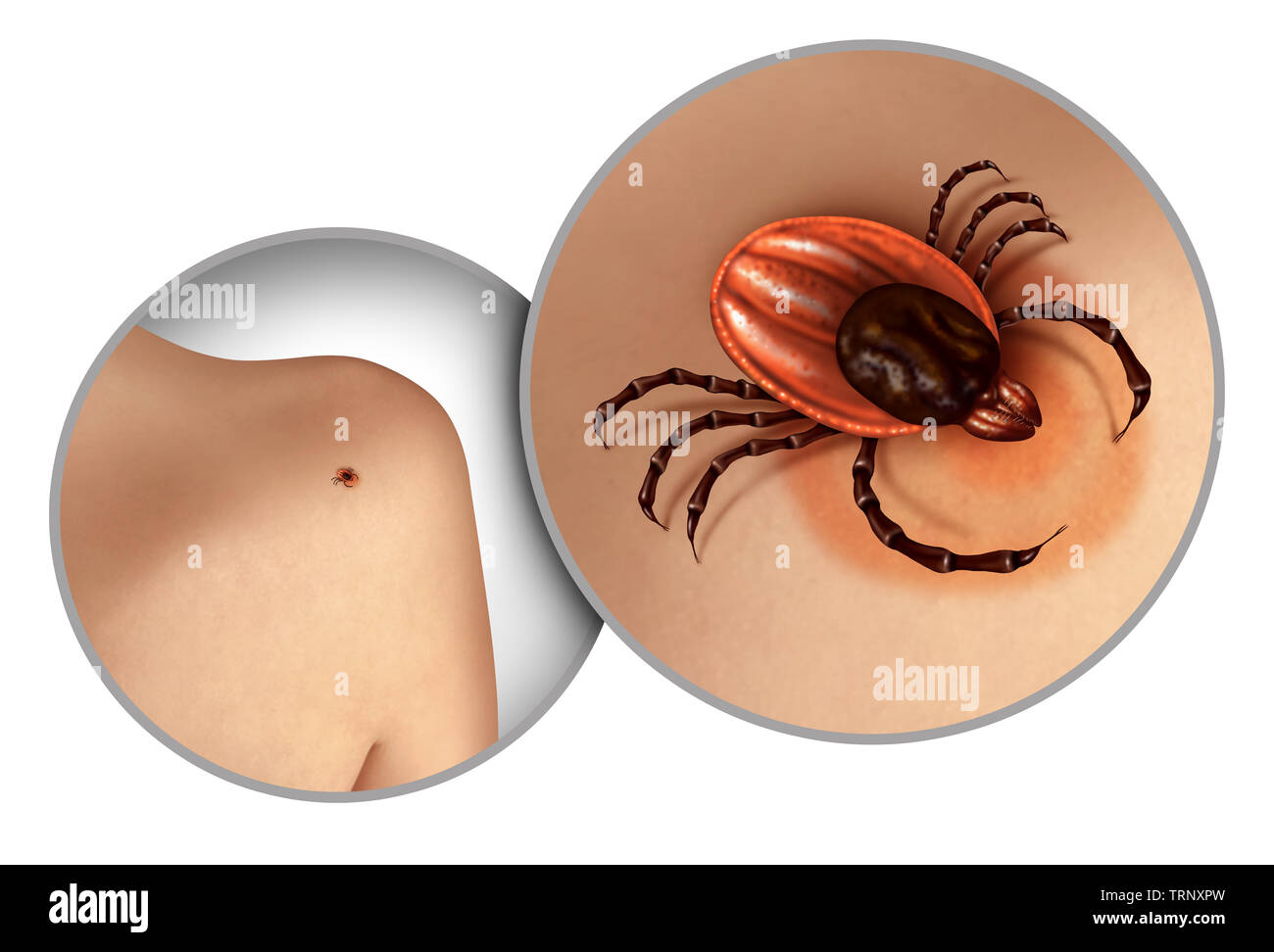 Deer tick crawling on skin as a lyme disease health danger as the bite of a parasite causing infection in a 3D illustration style. Stock Photo