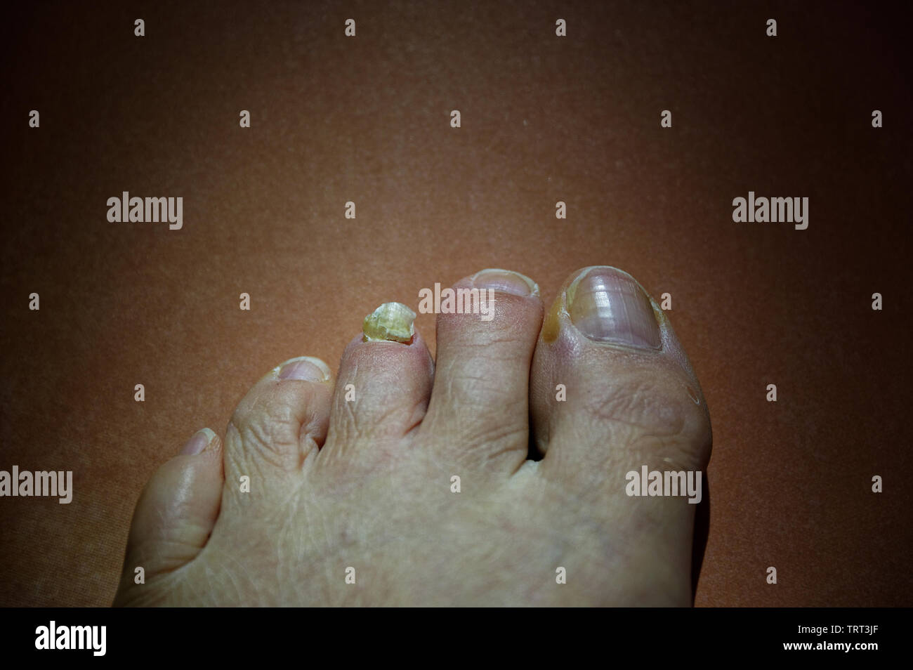 A toe nail barely hangs on to the base of the toe - ouch Stock Photo