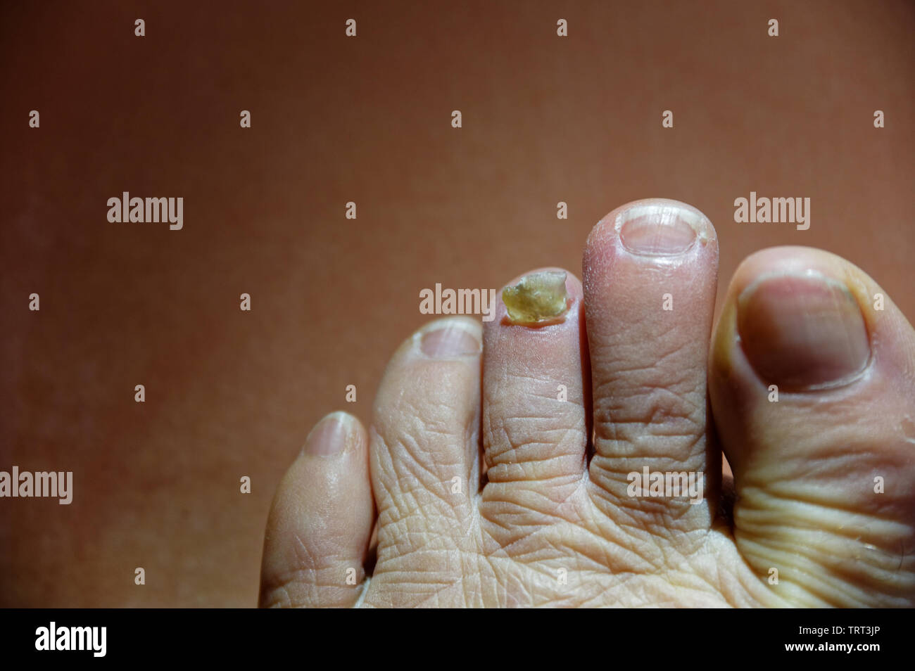 A foot looks like it could do with some first aid after having a toe nail pulled off Stock Photo