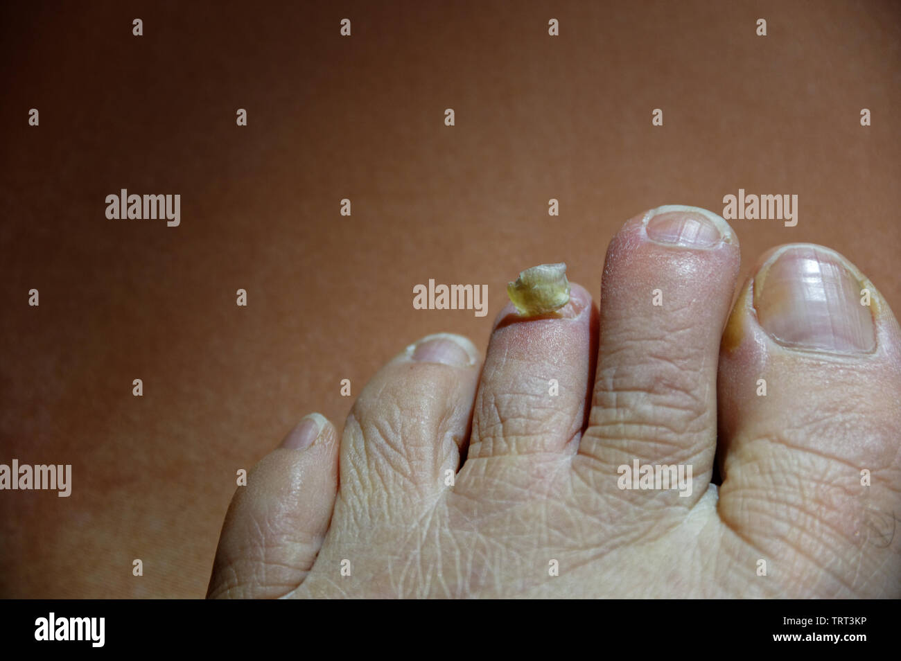 Attention is need for a poor toe that has lost its toenail Stock Photo