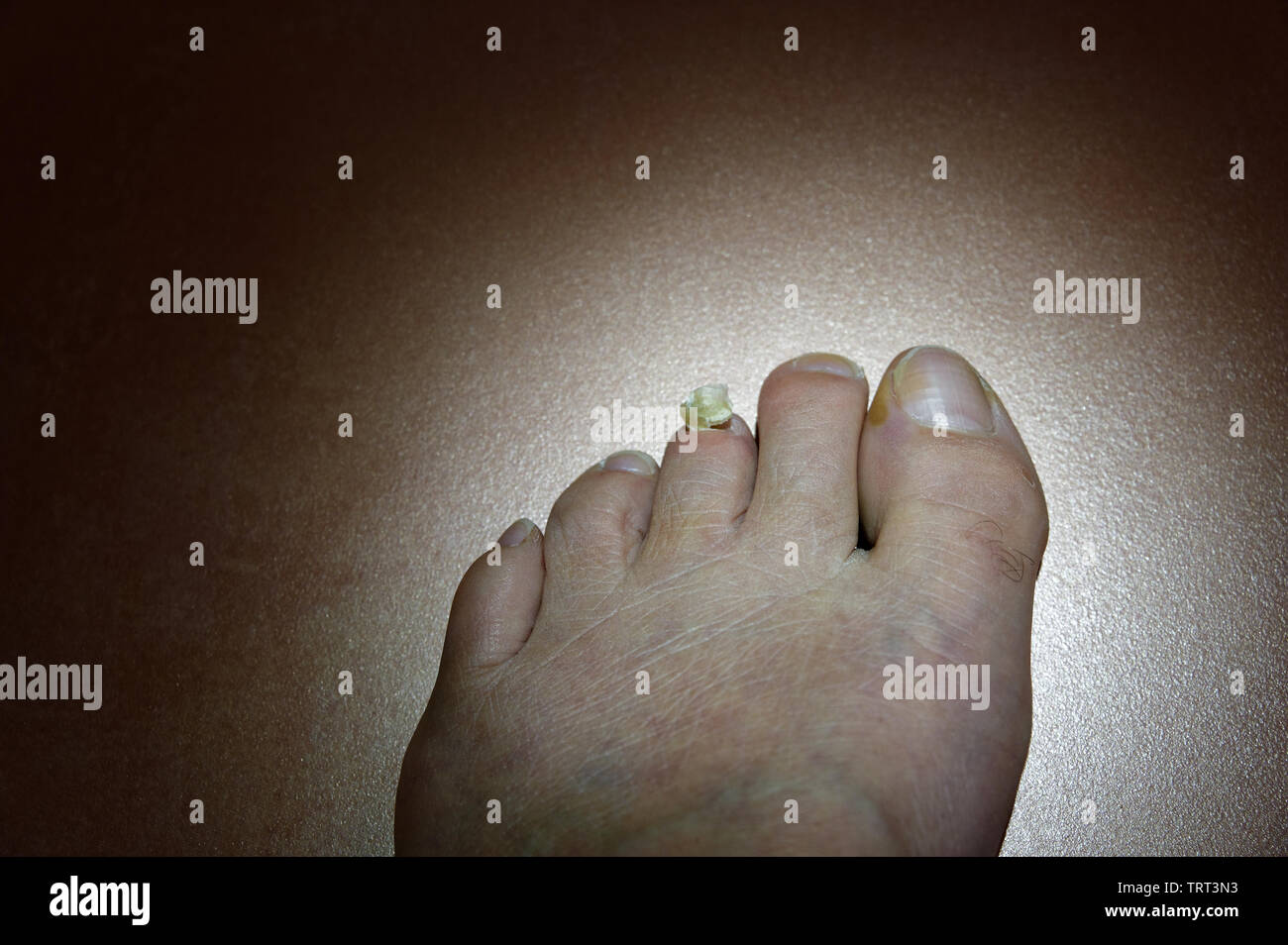 An unloved foot has a toe with a toenail ripped off Stock Photo