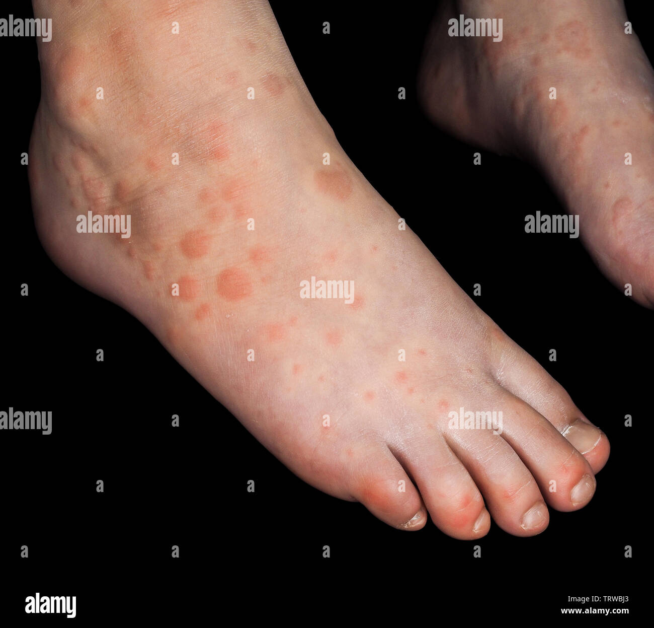Child with red rash from Coxsackievirus, on both feet, isolated on black Stock Photo