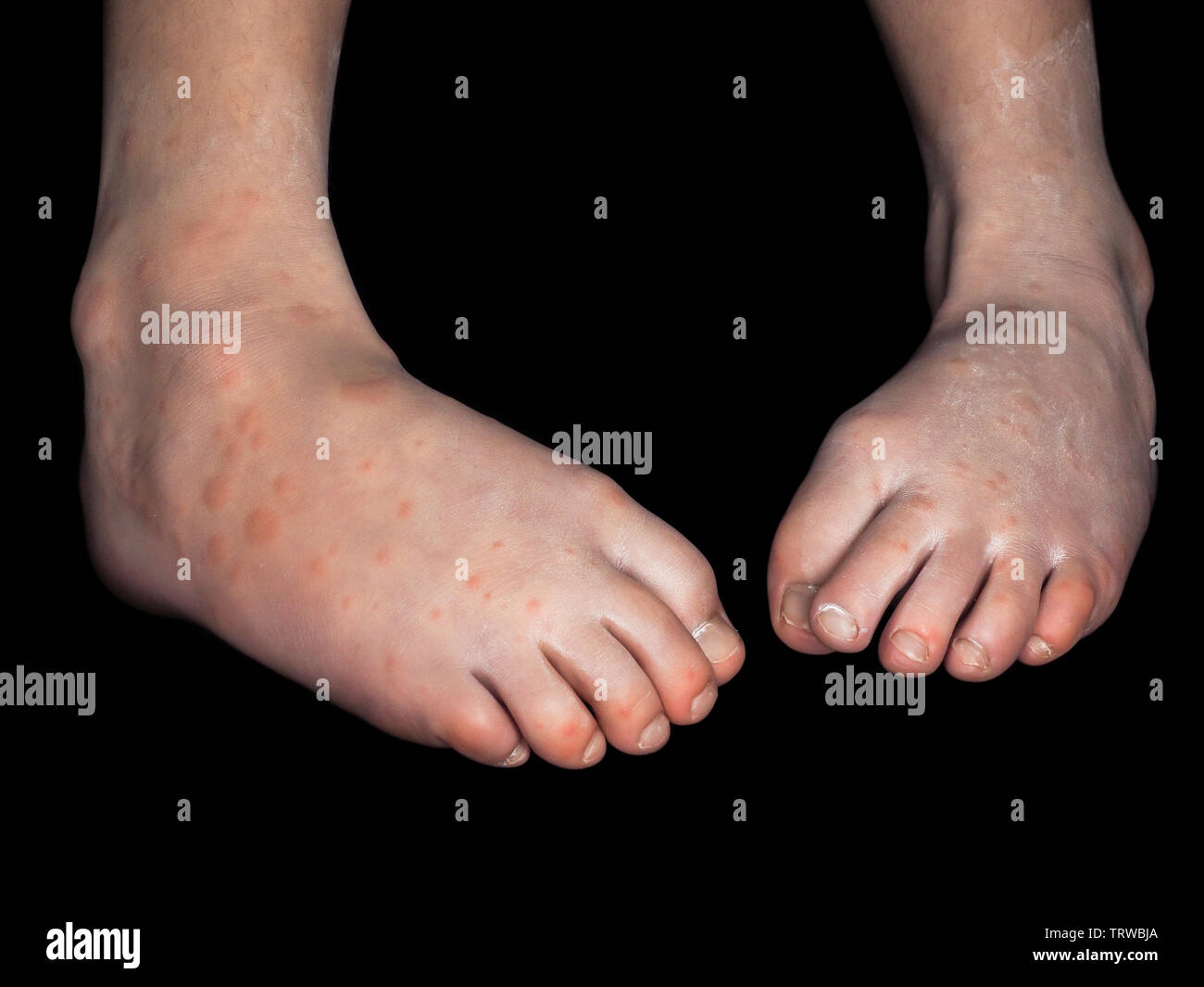 Child with red rash from Coxsackievirus, on both feet, isolated on