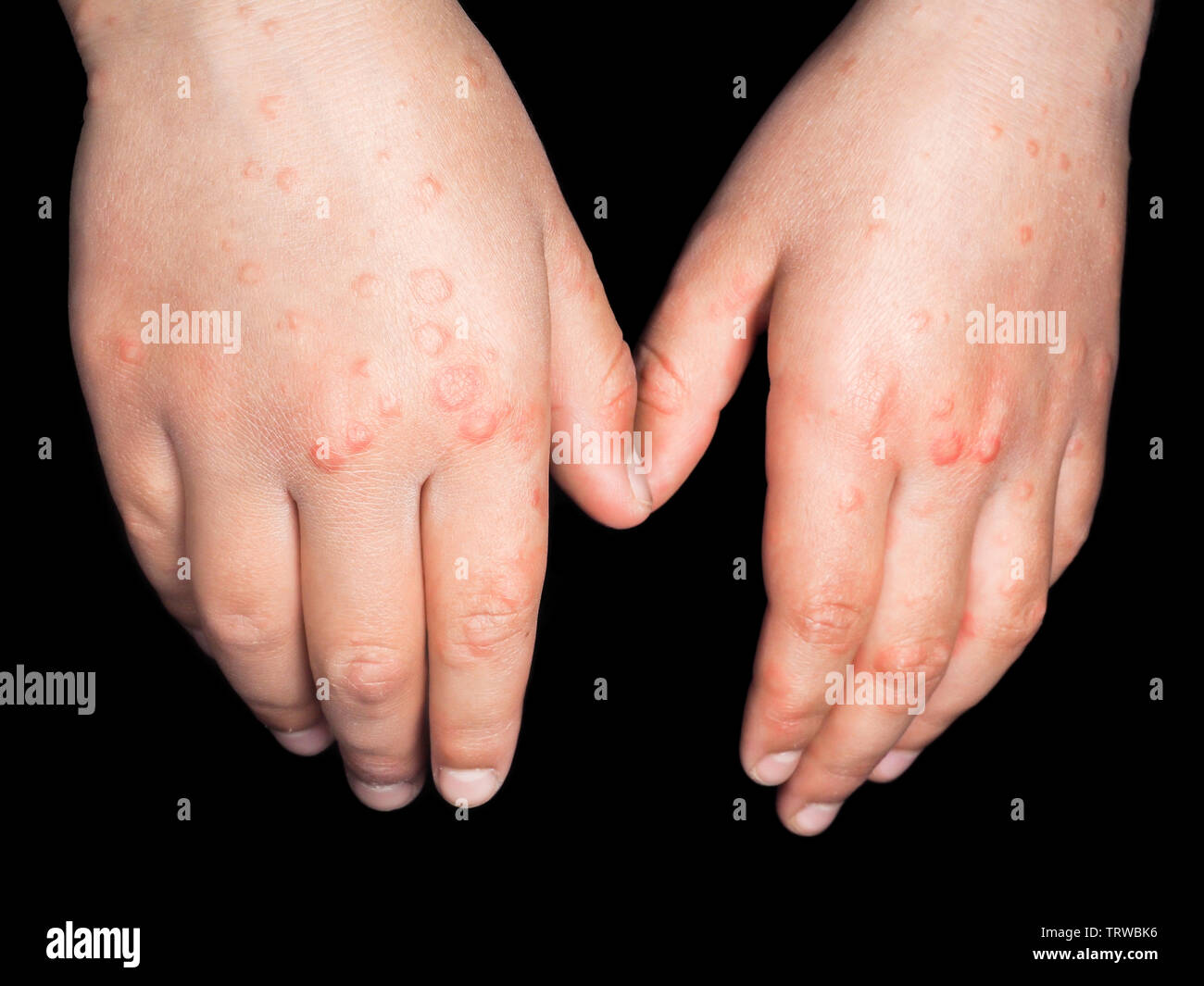Child with red rash from Coxsackievirus, on both hands, hands backside, isolated on black Stock Photo