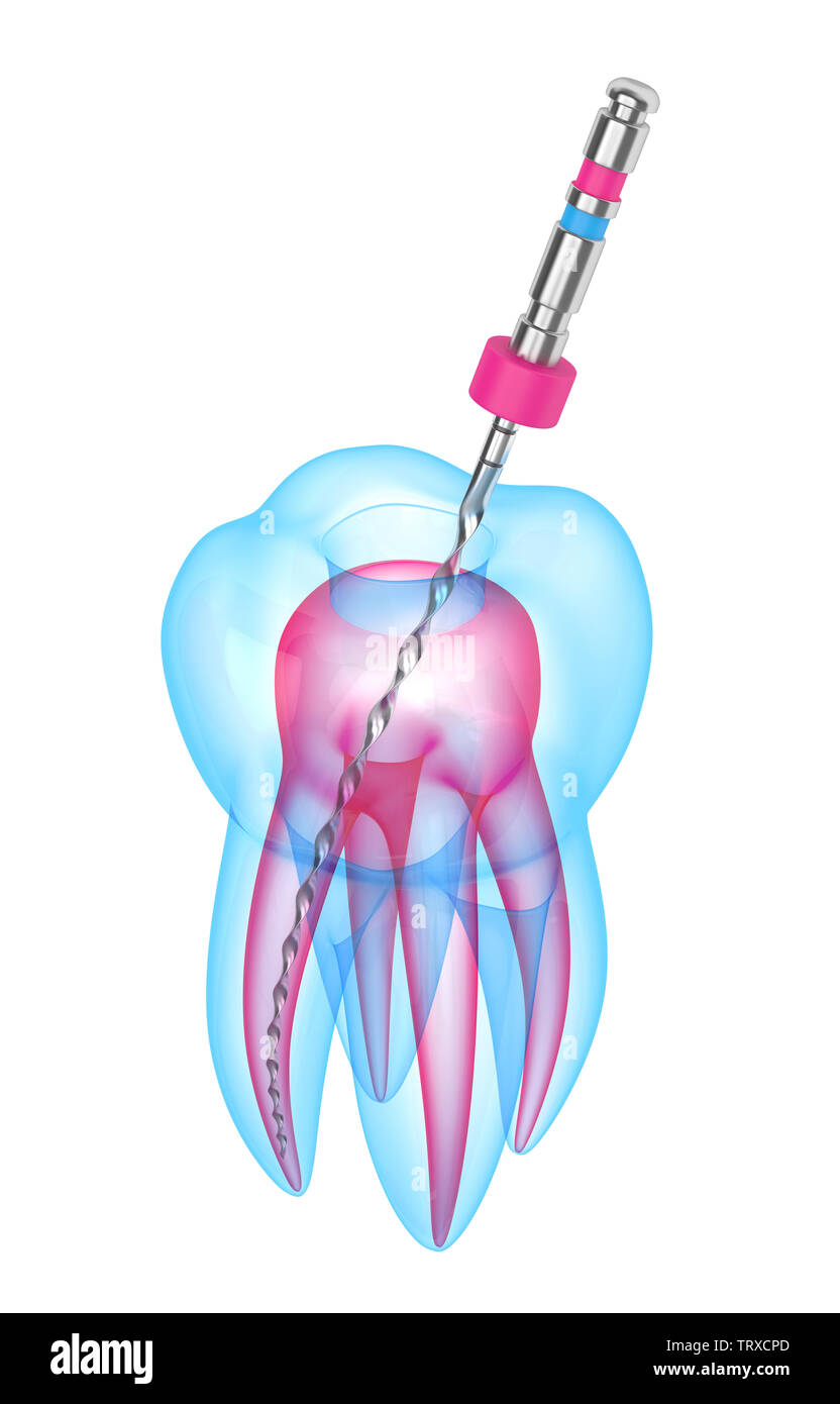 3d render of tooth with endodontic file over white background. Root