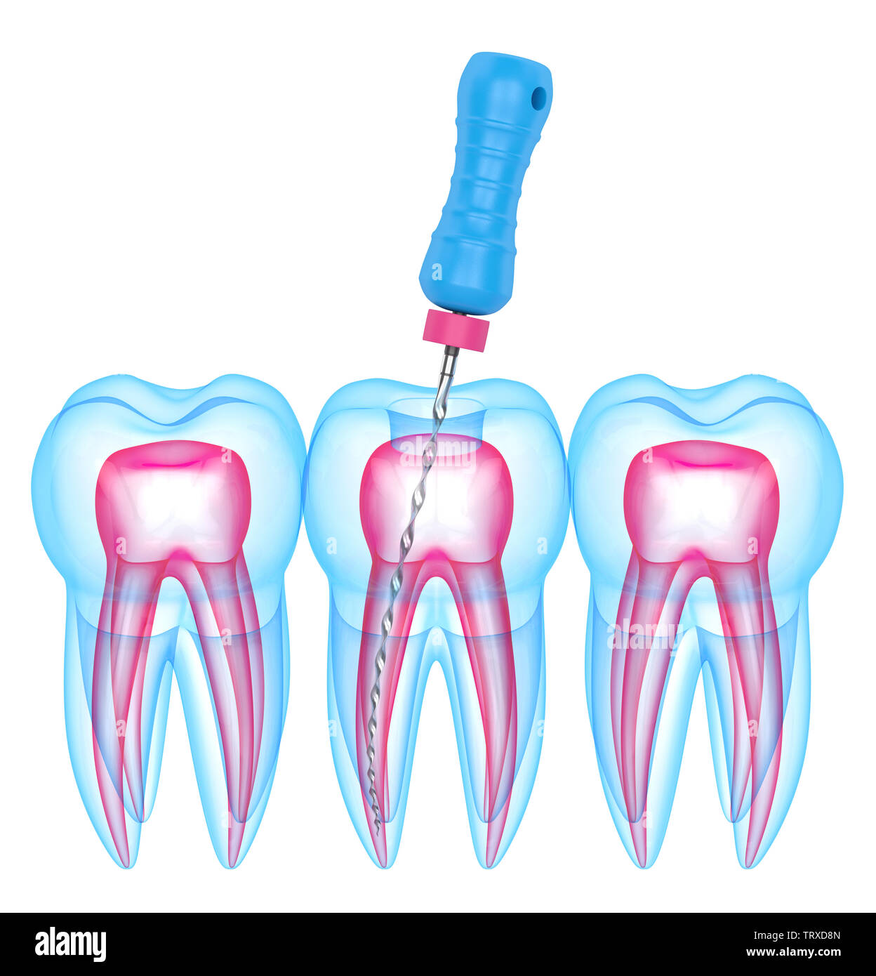 3d render of teeth with endodontic file over white background. Root