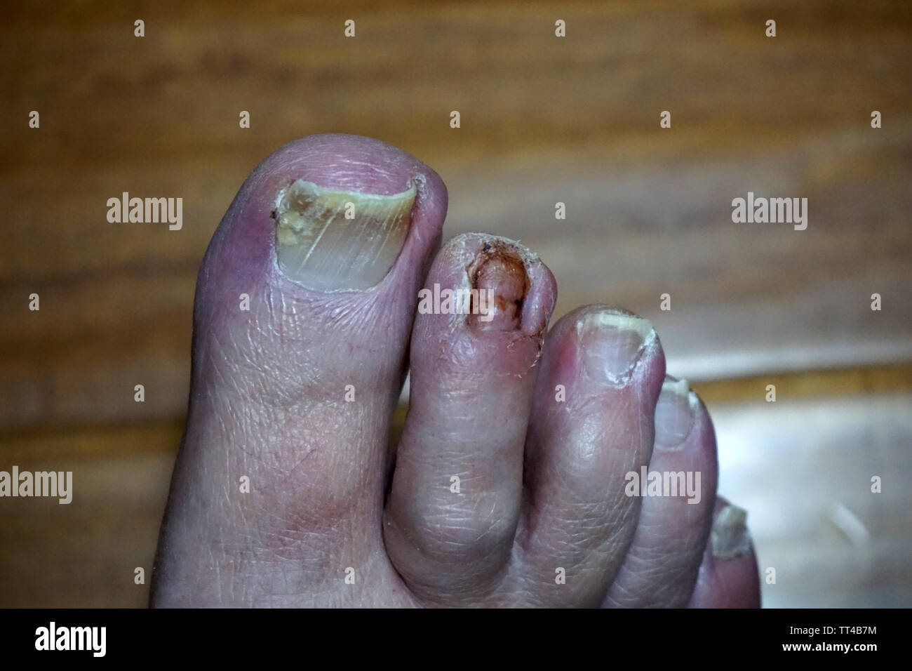 Discover 135+ broken foot nail best