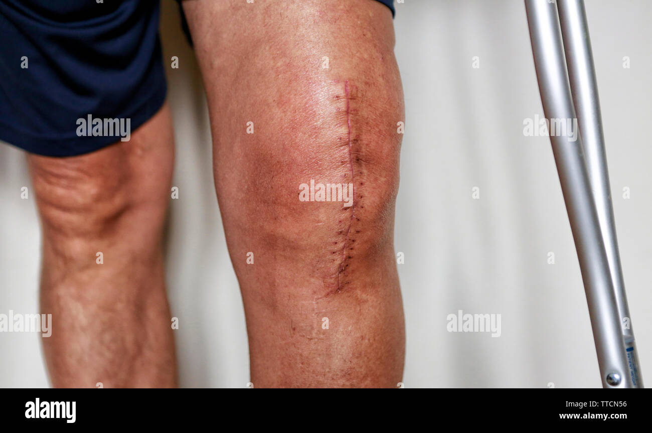 Man on crutches after knee replacement surgery, stitches close up. Painful scar after knee surgery Stock Photo