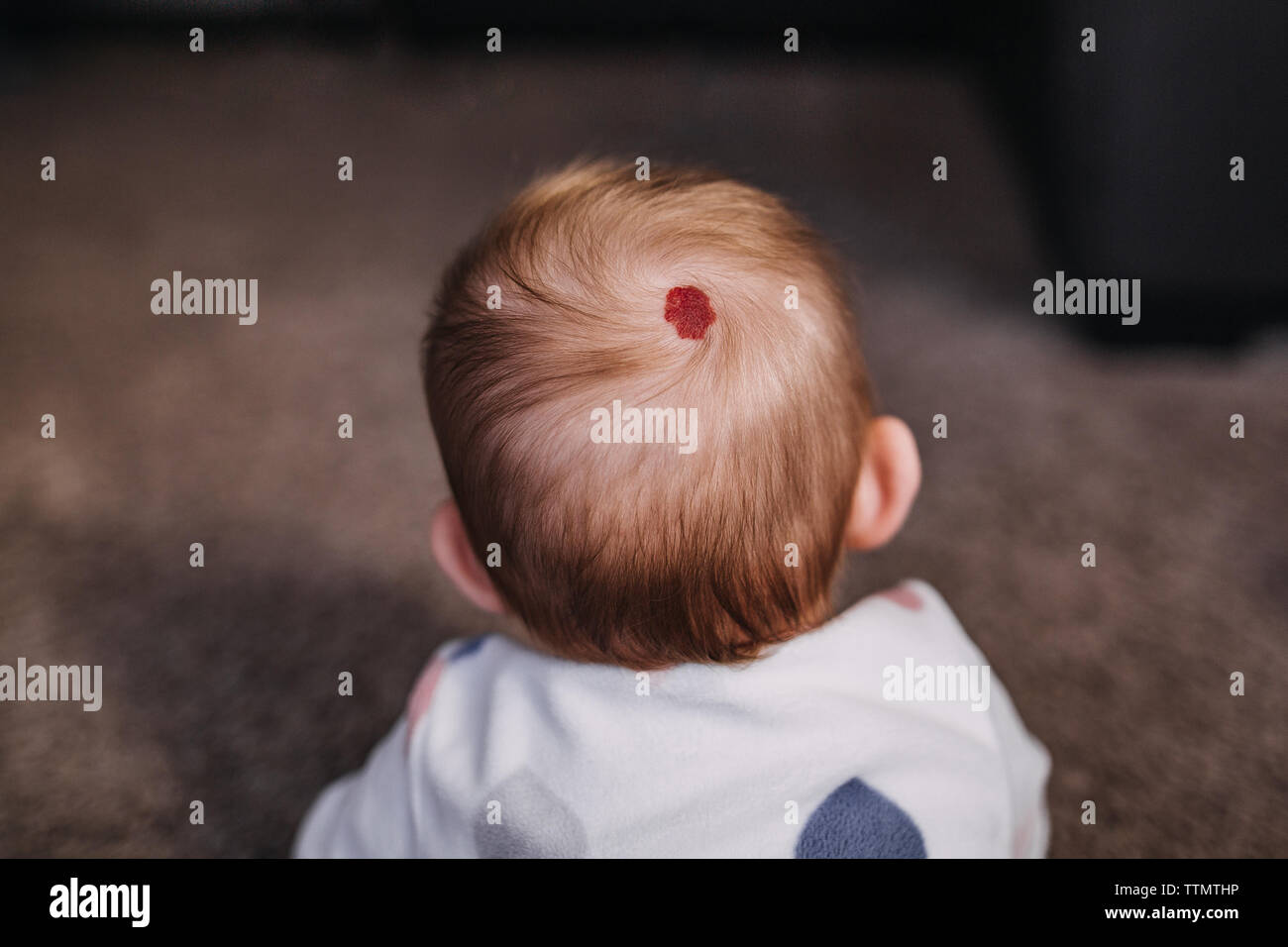 Red birthmark on head hires stock photography and images Alamy