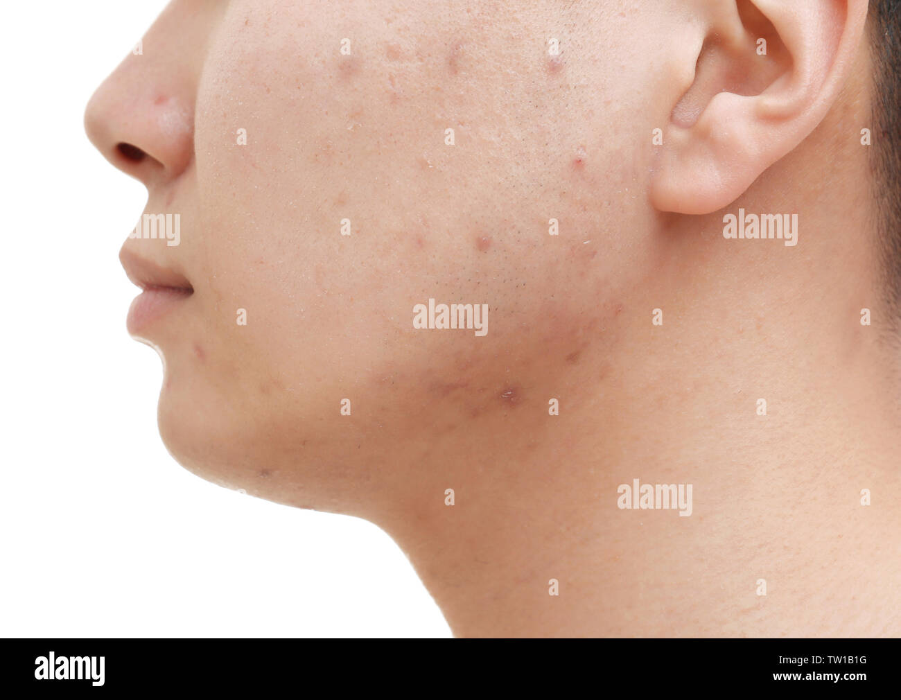 Young man with problem skin on white background, closeup Stock Photo