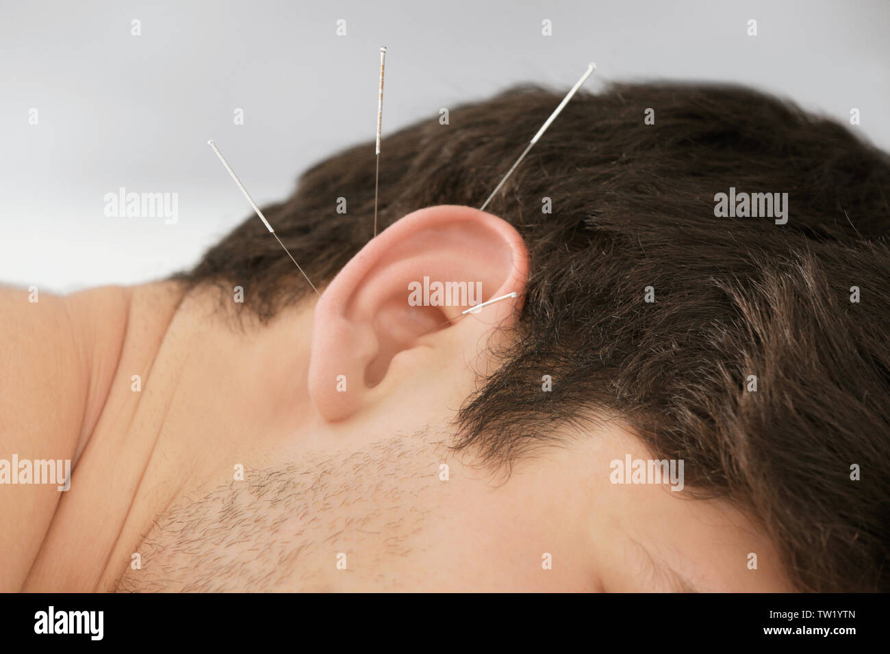 Man's ear with needles. Acupuncture concept Stock Photo Alamy