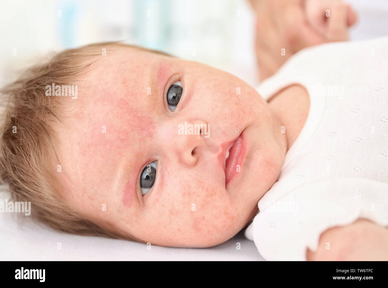 Skin Allergy High Resolution Stock Photography and Images Alamy