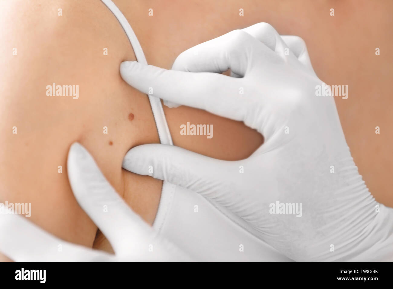 Dermatologist examining birthmark of patient, closeup. Cancer concept ...