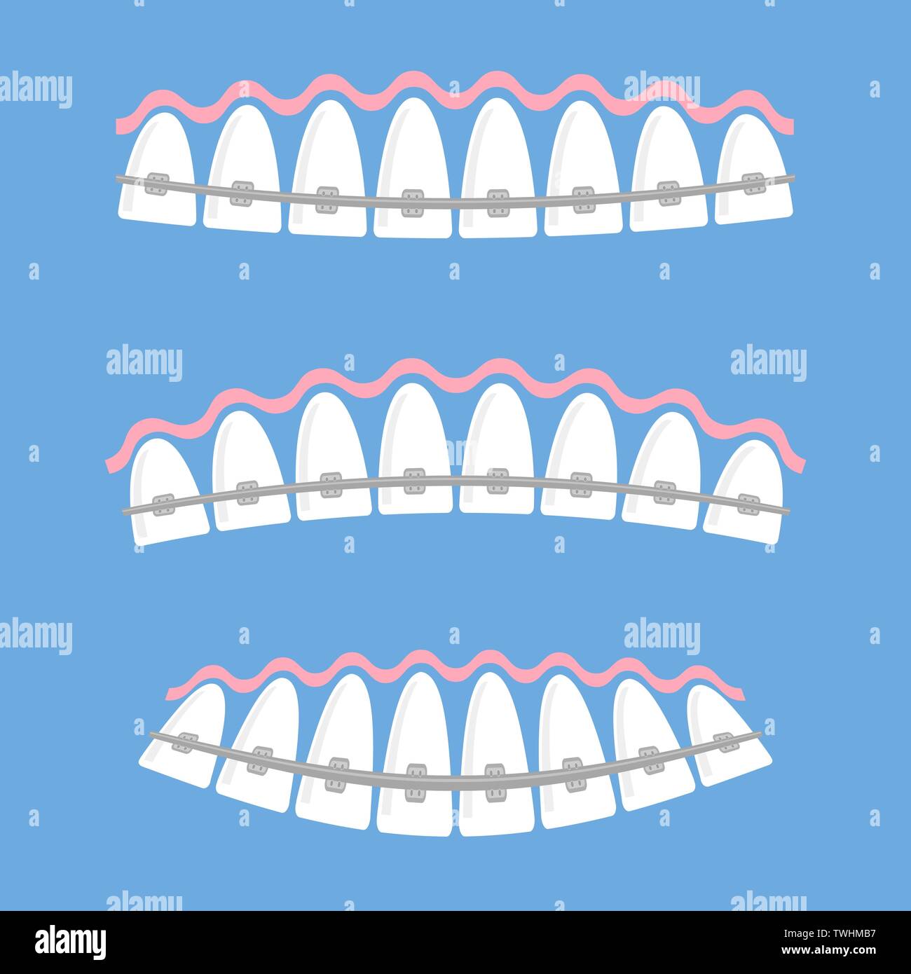 Medical Braces Teeth. Dental Care Background. Orthodontic Treatment