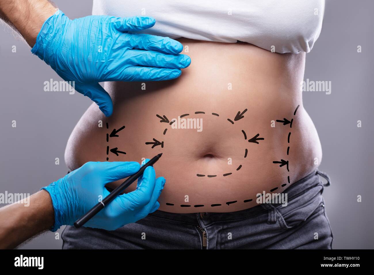 Close-up Of Plastic Surgeon In Blue Gloves Drawing On Woman's Stomach With Pen For Surgery Stock Photo