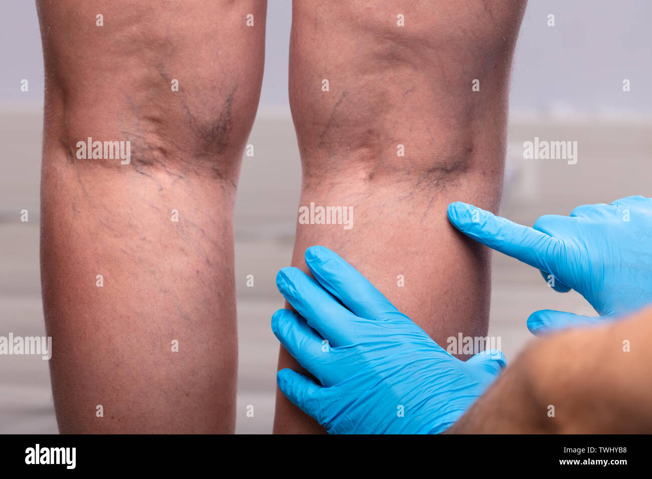 Medic With Blue Latex Surgical Gloves Touching Varicose Veins On Patient's Leg Stock Photo