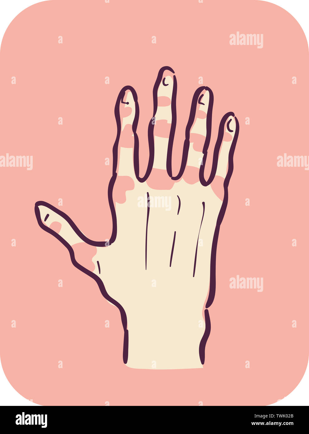 Illustration of a Hand with Fingers and Knuckles Showing Redness on Each Joint Stock Photo Alamy