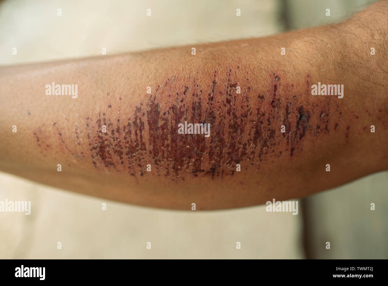 Skin injury with deep scratches on leg (as a result of falling during a hike) on adult man. RF healing wound example stock image. Stock Photo