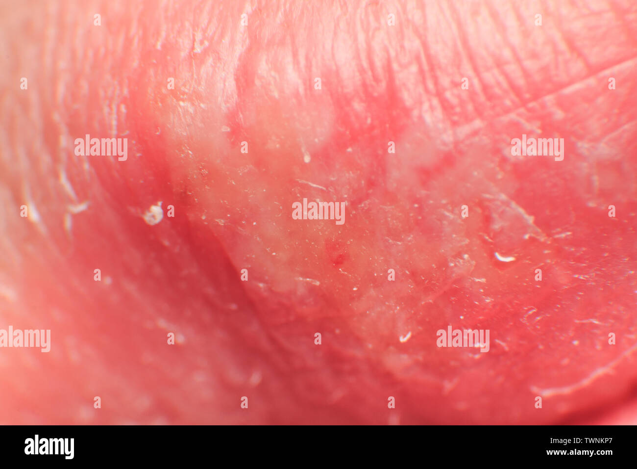 Second day of growing herpes on caucasian male man on front upper lip super macro microscope Stock Photo