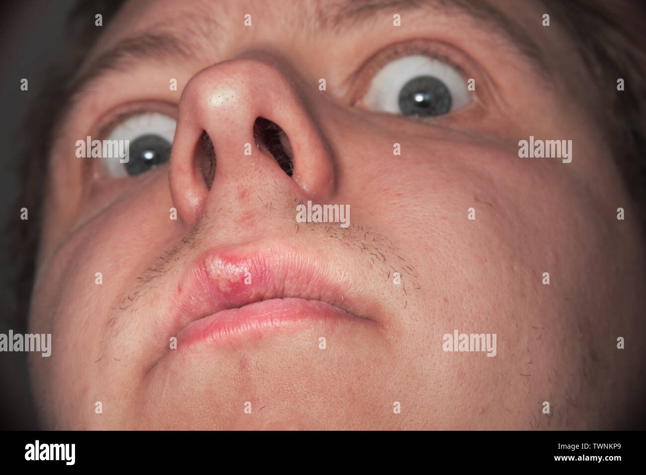 Big scary eyes and herpes on upper lip. Caucasian man Stock Photo