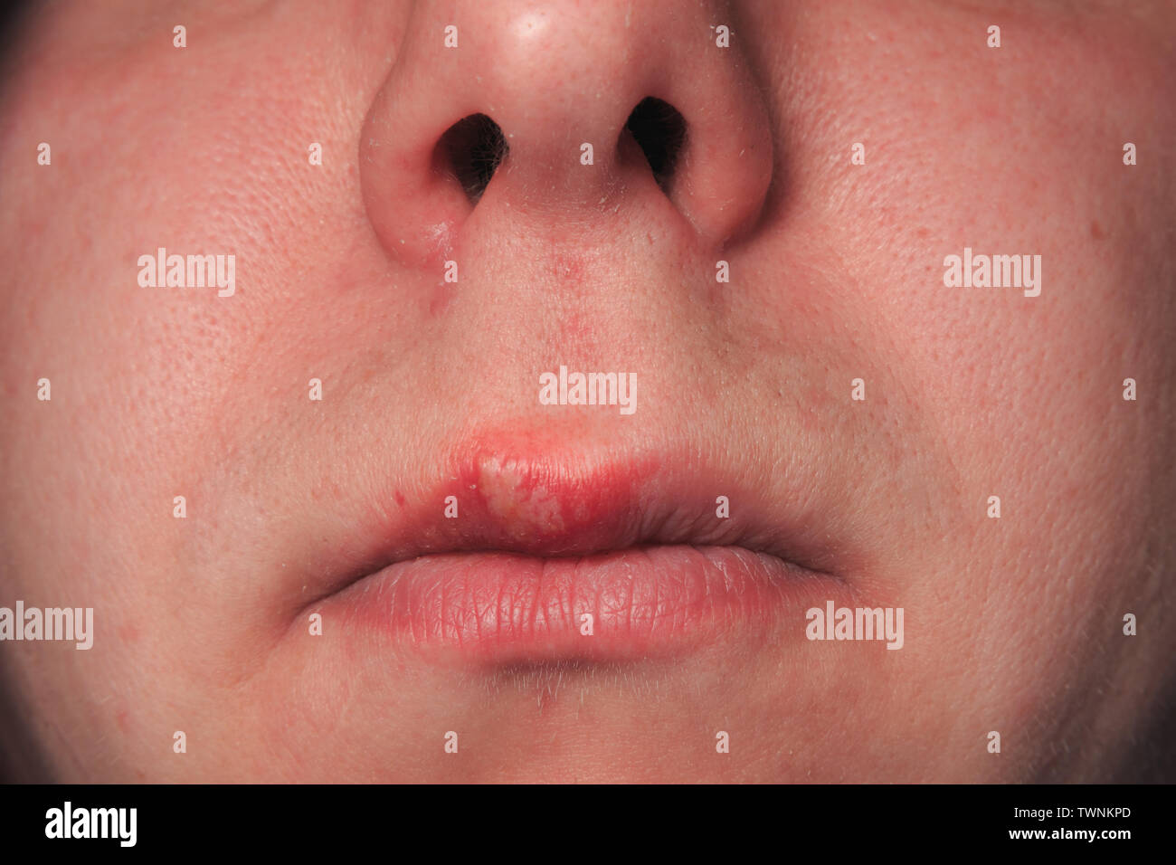 Second day of growing herpes on caucasian male man on front upper lip Stock Photo