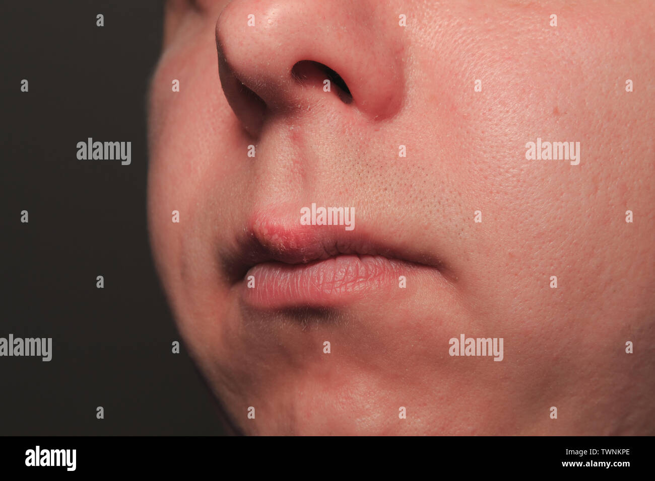 Second day of growing herpes on caucasian male man on front upper lip Stock Photo