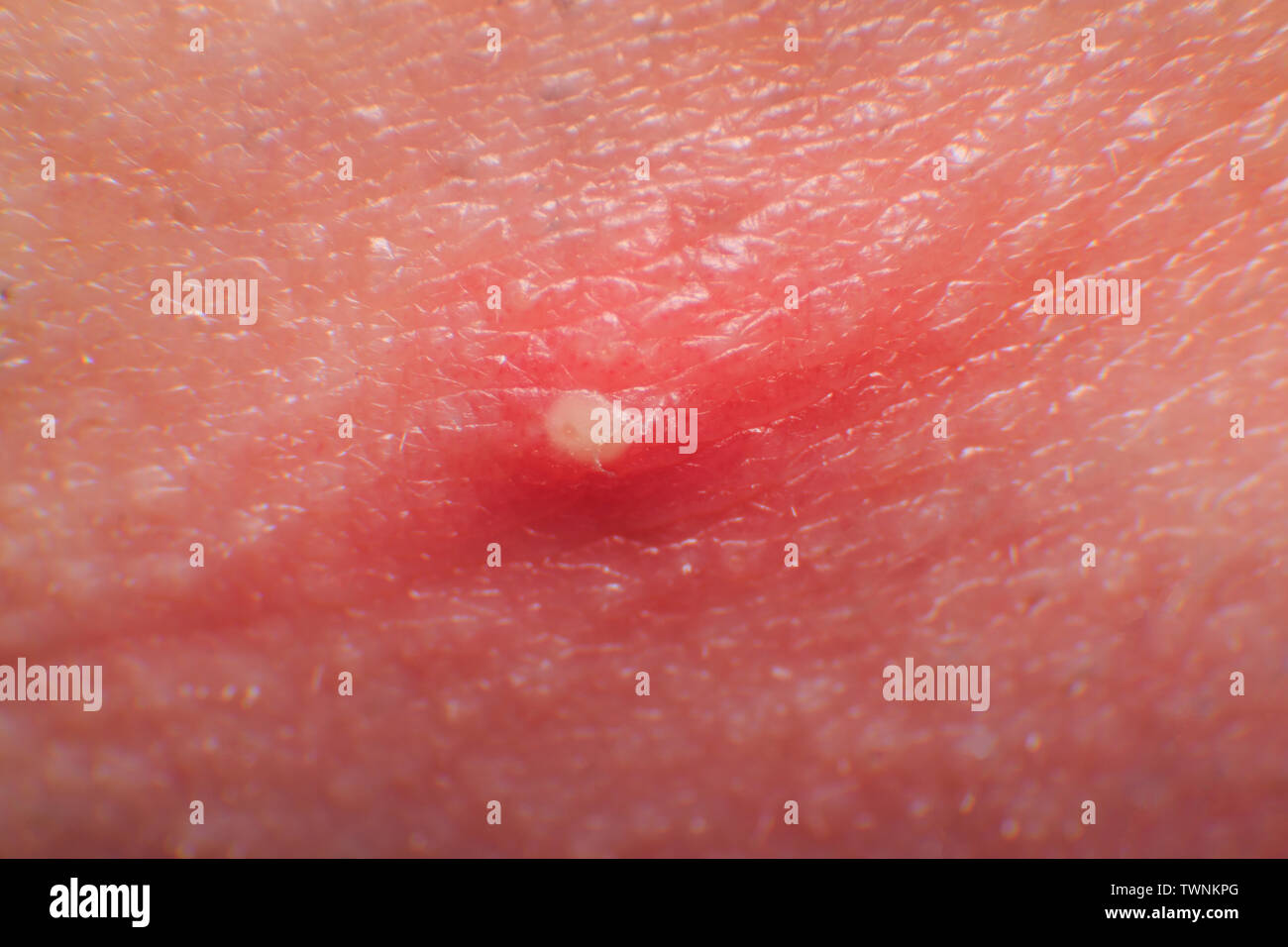 White pimple hair follicle inflammation on adult man skin Stock Photo