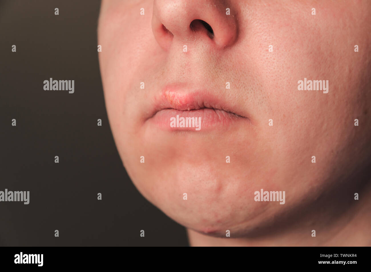 Herpes mouth infection hires stock photography and images Alamy